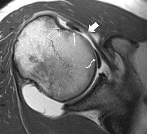 How to read mri images for a torn rotator cuff - alohadelta