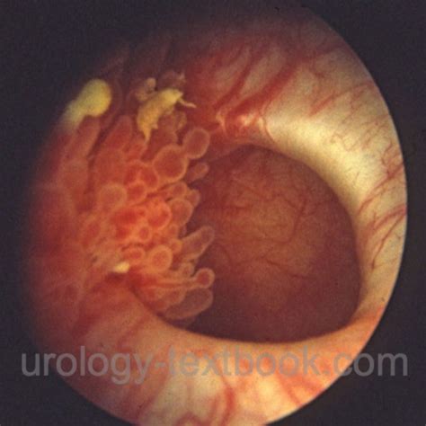 Bladder Diverticulum: Etiology, Diagnosis and Treatment