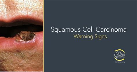 Squamous Cell Carcinoma Warning Signs and Images - The Skin Cancer ...