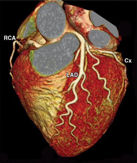 CT of Coronary Artery Disease | Radiology