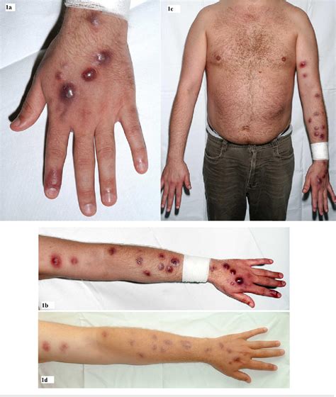 Figure 1 from A rifampicin-resistant Mycobacterium marinum infection in ...