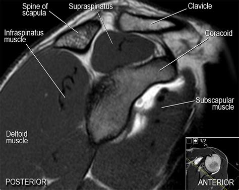 Shoulder Anatomy and Variants on MRI (2022)