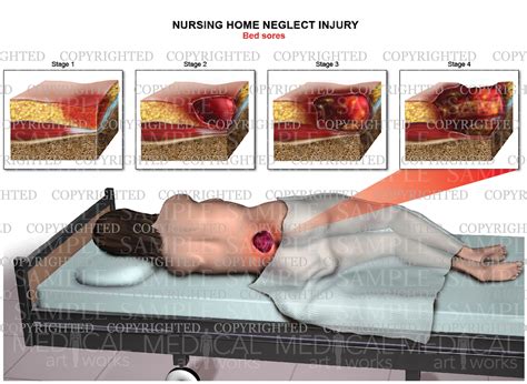 Nursing home neglect injury - Bed sores stages – Medical Art Works