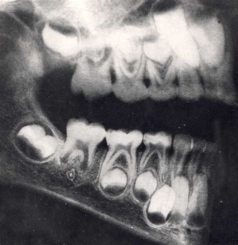 radiographic profile, mixed dentition Dental Assistant, Dental Hygiene ...