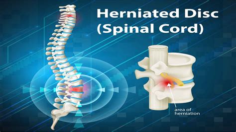 Herniated Disc