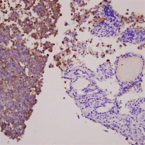 (PDF) A Case of Thyroid Metastasis Originating from Early Gastric Cancer