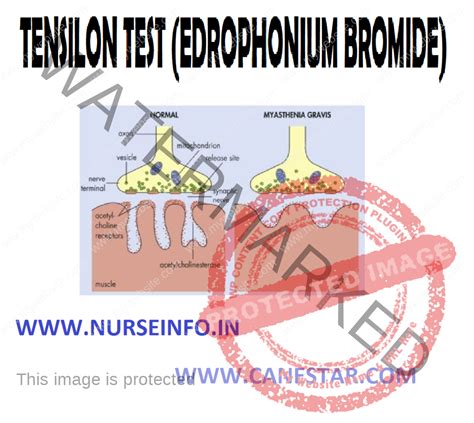 TENSILON TEST (EDROPHONIUM BROMIDE) - Nurse Info