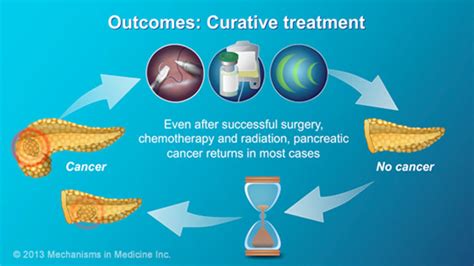 Slide Show - Pancreatic Cancer - Treatment and Outcomes