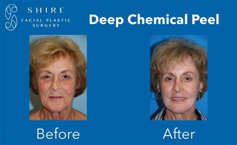 Deep Chemical Peels Before & After | Shire Facial Plastic Surgery