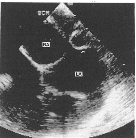 Transoesophageal echocardiogram showing a left persistent superior vena ...