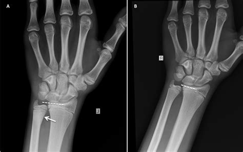 Distal Ulna Fracture Splint