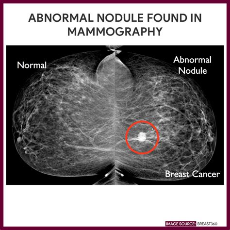 Mammography (Mammogram) - Nursing Responsibilities - Nurseslabs