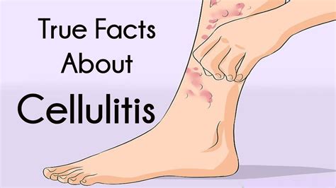 Cellulitis Rash Stages