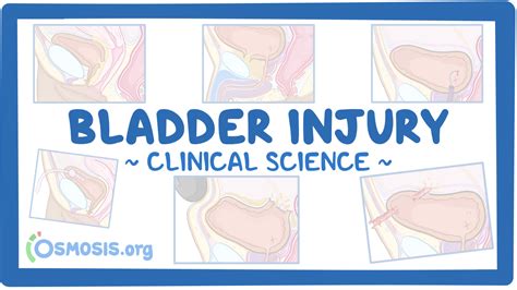 Bladder injury: Video & Meaning | Osmosis