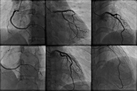 Coronary Angiographycardiac Catheterization The Cardi - vrogue.co