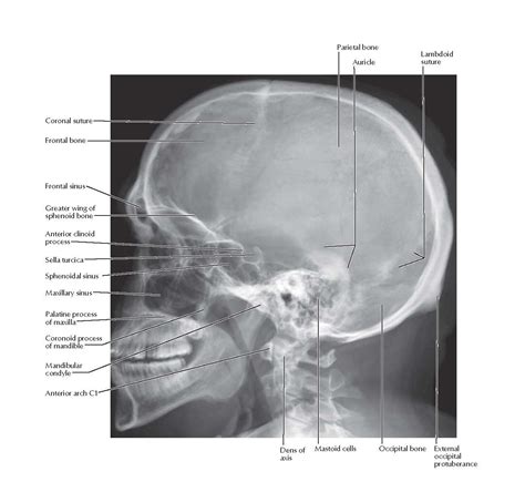 Skull: Lateral Radiograph Anatomy - pediagenosis