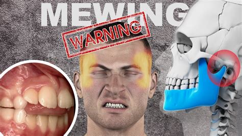 The Dangers of Mewing/Jawline Exercises - YouTube