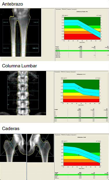¿Qué es una densitometría ósea? - Cedor