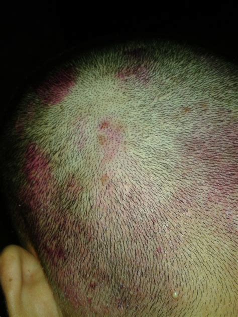 Eczema Scalp Pictures – 10 Photos & Images / illnessee.com