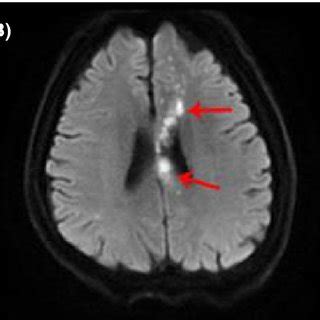 MRI images showing acute cerebral infarction in multiple sites of the ...