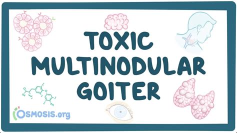 Toxic multinodular goiter: Video, Causes, & Meaning | Osmosis