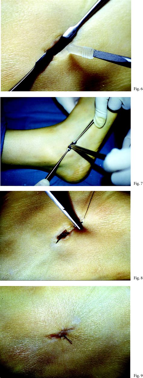 Talipes Calcaneovalgus | Semantic Scholar