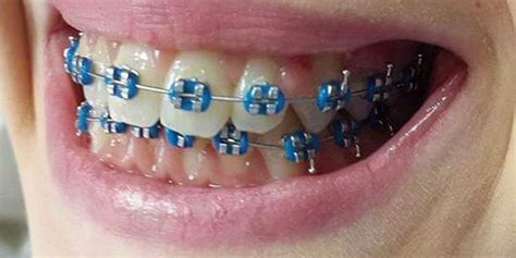 Braces Colors Blue