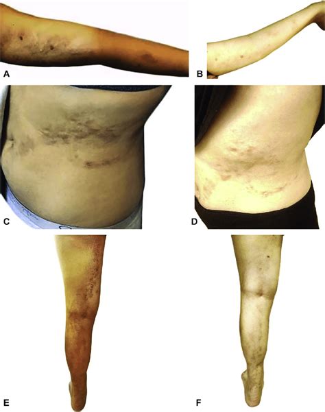 Baseline and posttreatment clinic photographs of tumid lupus ...