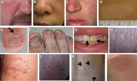 Tuberous Sclerosis Complex–Associated Angiomyolipomas: Focus on mTOR ...