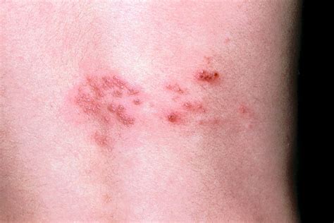 Painful Shingles Can Strike More Than Once - WSJ