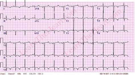 Left Ventricular Hypertrophy With Strain Pattern (Example 4 ...