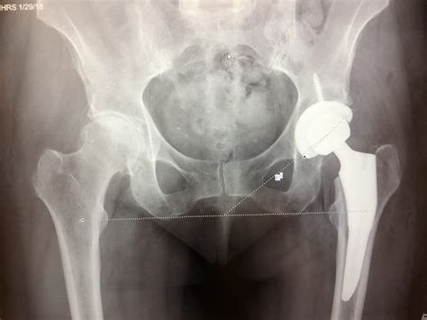 Anterior Hip Replacement Surgery: An Overview - OSMS - Orthopedic and ...