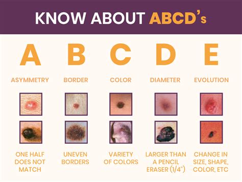 Main Types Of Skin Cancer