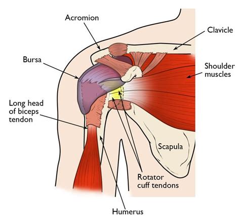 Shoulder Impingement Rotator Cuff Tendinitis