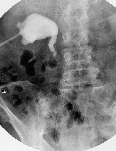 Hydronephrosis - investigation and treatment | Image | Radiopaedia.org