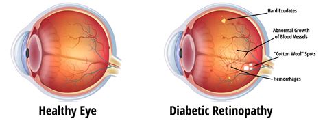 Diabetic Retinopathy in Victorville, CA | High Desert Institute of ...