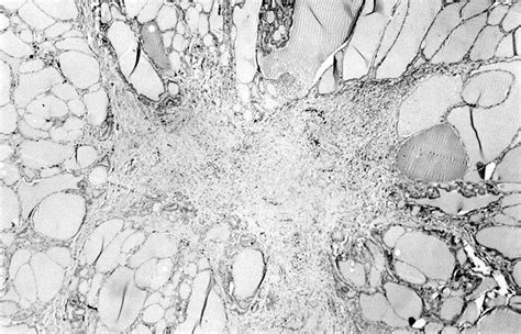 Pathology Outlines - Riedel thyroiditis