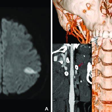 A: Diffusion-weighted MRI showing a cerebral infarction in the left ...