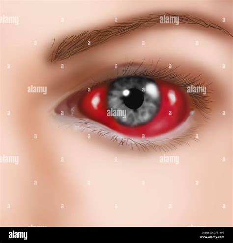 Eye hemorrhage hi-res stock photography and images - Alamy