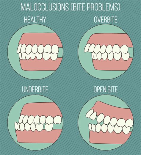 Does the malocclusion (bite problems) effect your daily life? / ฟอกฟัน ...