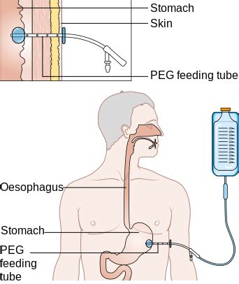 What is a Feeding Tube? - Types & Complications | Study.com