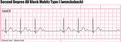 Heart block causes, symptoms, types, diagnosis and heart block treatment