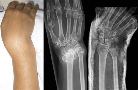 Moore fracture • LITFL Medical Blog • Medical Eponym Library