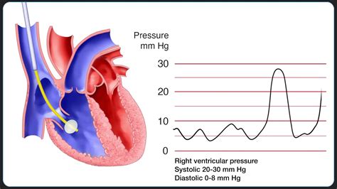 Insertion of a Pulmonary Artery (Swan-Ganz) Catheter - YouTube