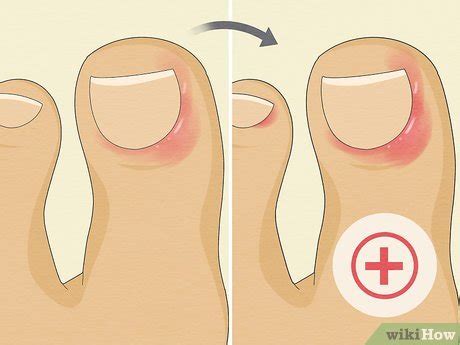 How to Treat Acute & Chronic Paronychia: Expert-Backed Tips