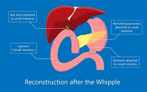 Whipple Surgery: Advanced Pancreatic Treatment at SCMSC