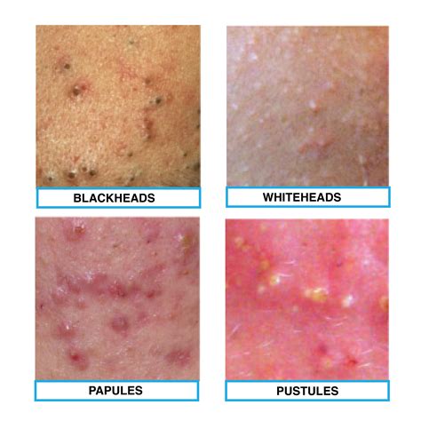 The four types of acne: blackheads, whiteheads, papule and pustules ...