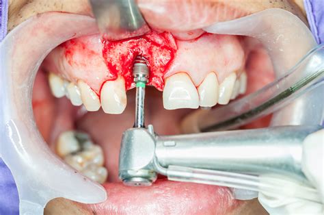 What You Need To Know About Dental Bone Graft Surgery - USIW.org