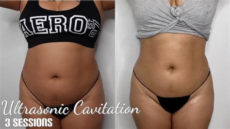 Ultrasonic Cavitation & Laser Lipo | Before and After photos| Full ...