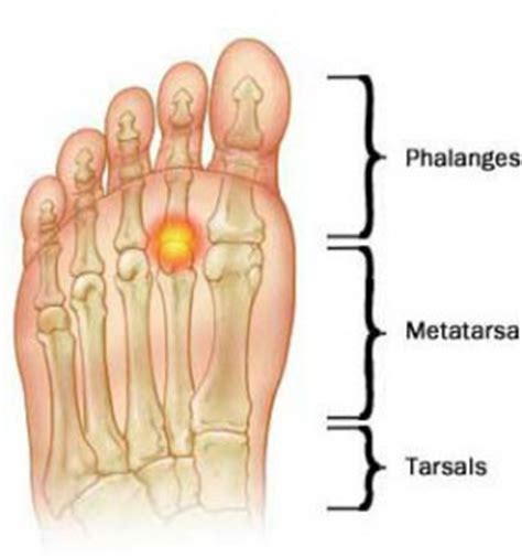 Podiatrist Phoenix & Scottsdale AZ | 5 Signs You Have Metatarsalgia